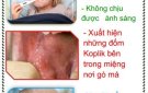 BÀI TUYÊN TRUYỀN PHÒNG BỆNH SỞI