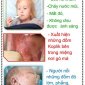 BÀI TUYÊN TRUYỀN PHÒNG BỆNH SỞI