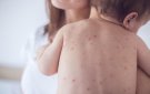 BÀI TUYÊN TRUYỀN VỀ BỆNH SỞ VÀ CÁCH PHÒNG CHỐNG