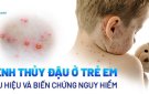 BÀI TUYÊN TRUYỀN BỆNH THỦY ĐẬU VÀ CÁCH PHÒNG NGỪA